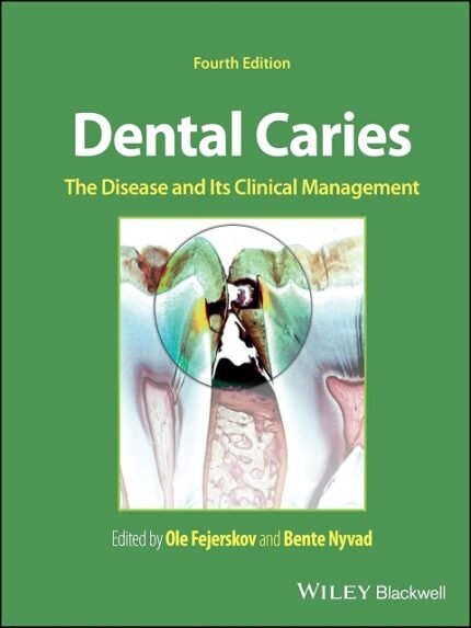 Dental Caries The Disease and its Clinical Management